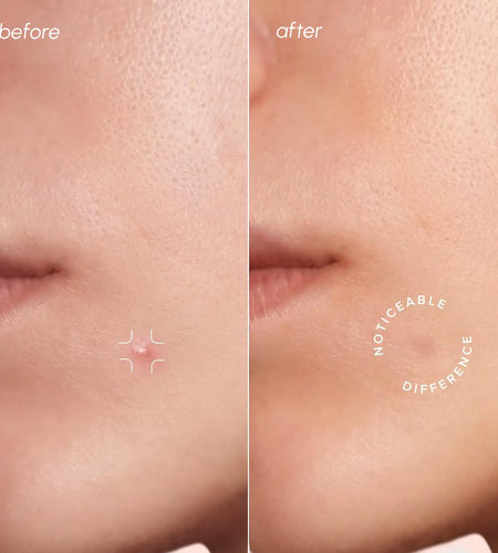 Invisible Pimple & Acne Patches