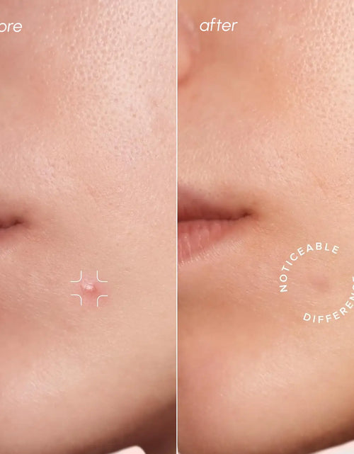 Load image into Gallery viewer, Invisible Pimple &amp; Acne Patches
